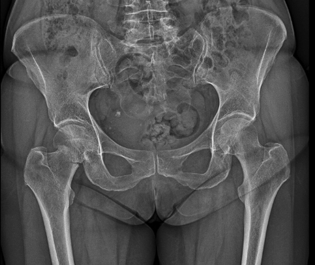 Hip fracture, X-ray