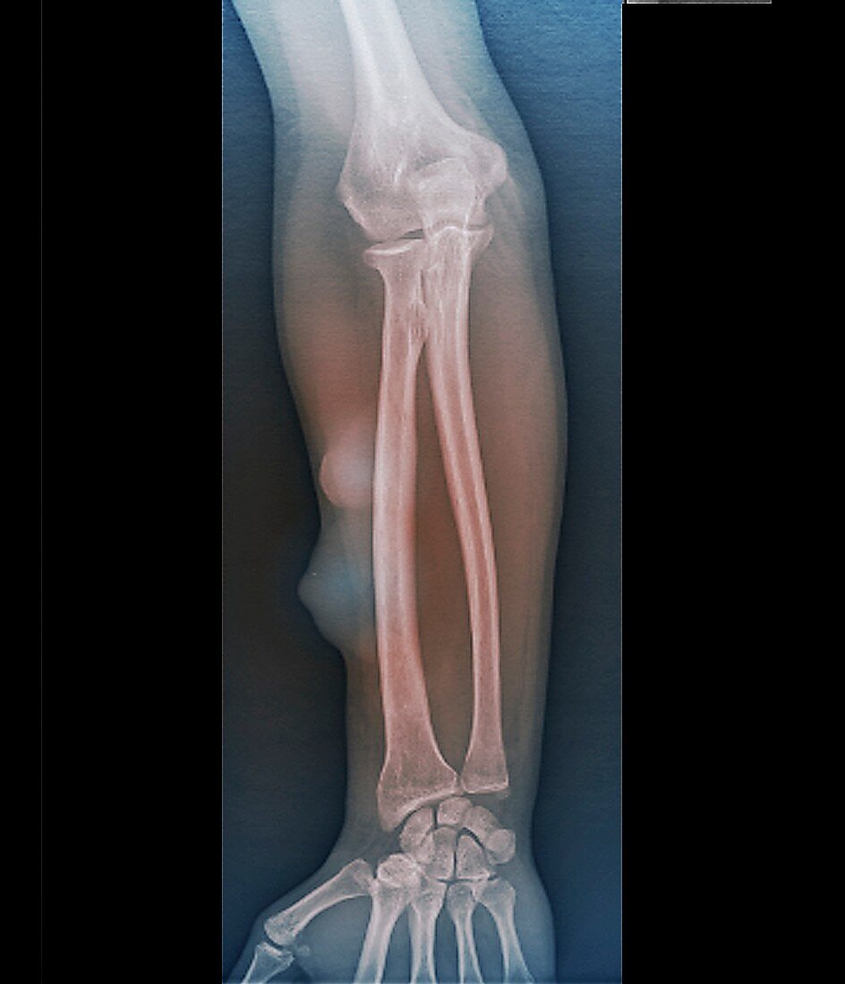 Subcutaneous lipomas on the arm, X-ray