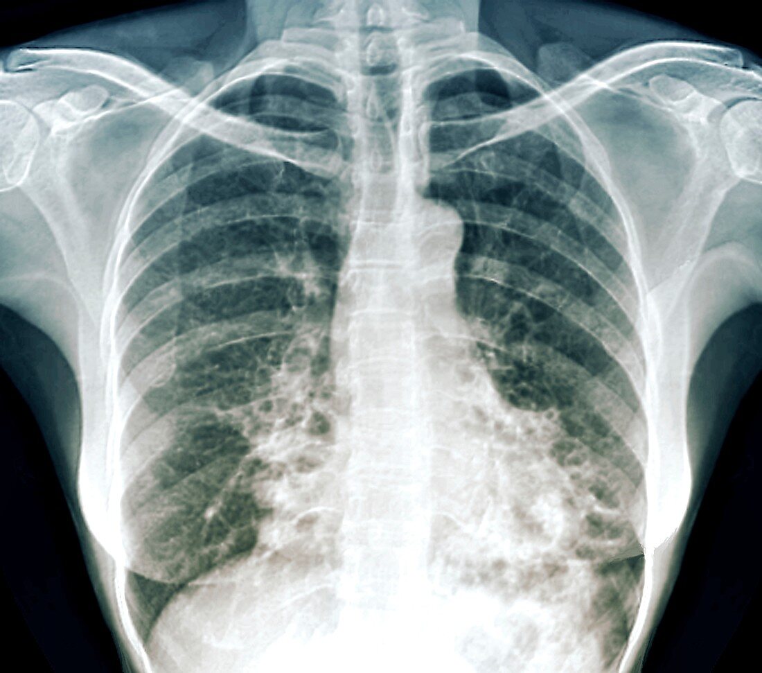 Bronchiectasis, X-ray