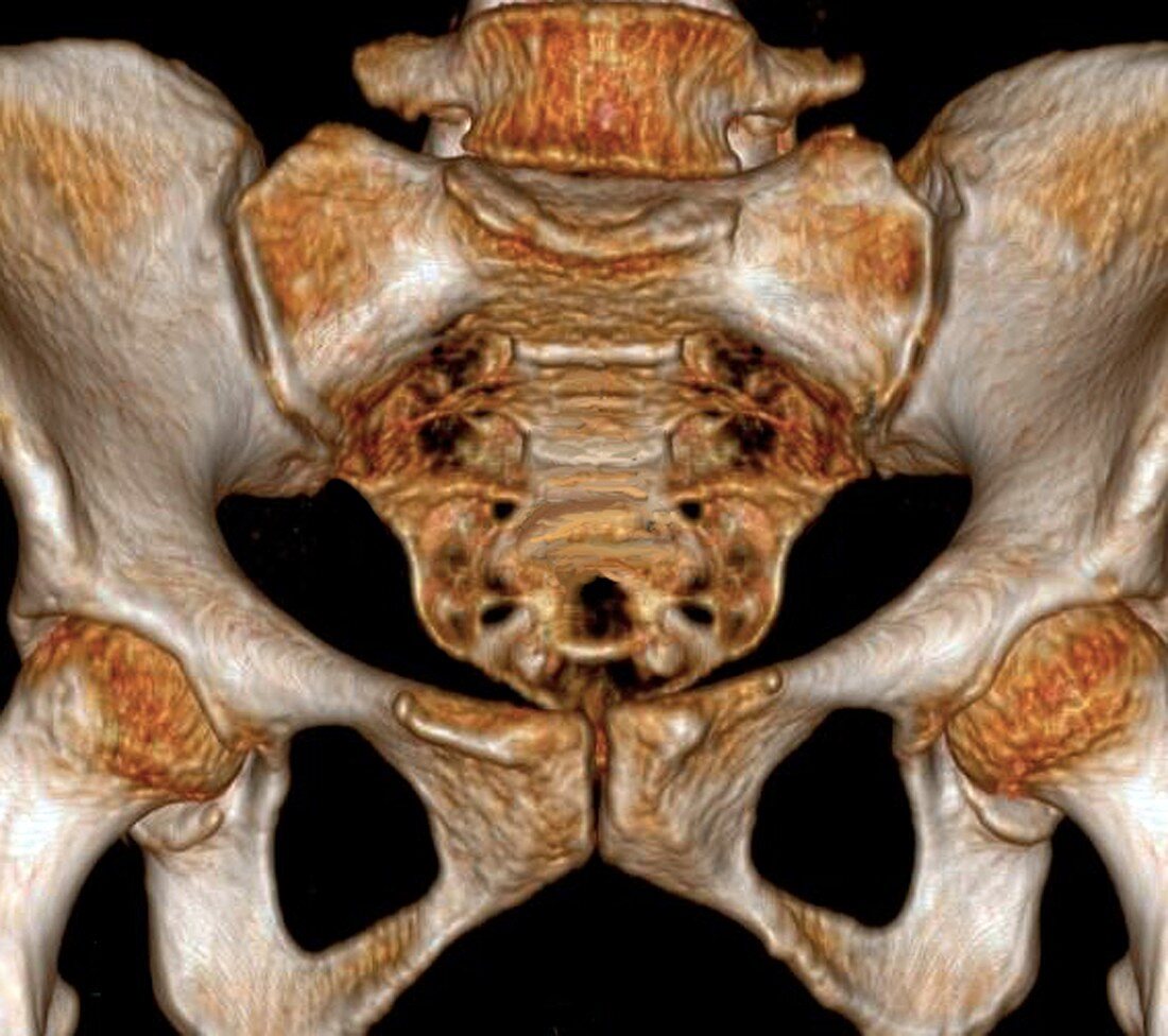 Front of pelvis and base of spine, 3D CT scan