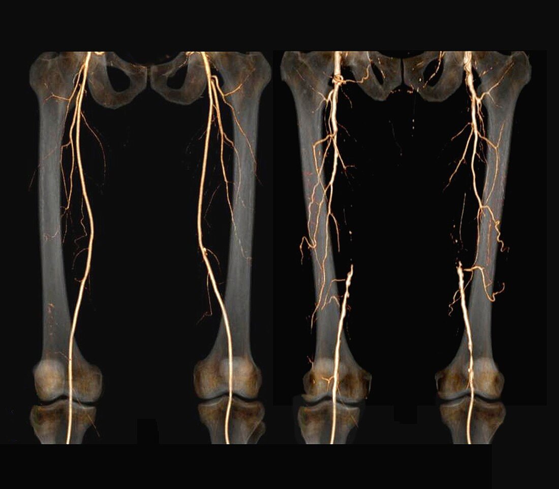 Effects of arteritis in the thigh, 3D CT angiogram