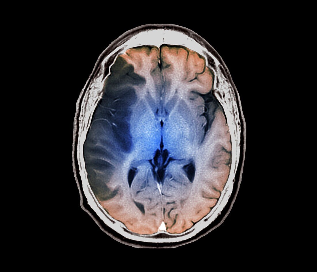 Stroke, MRI brain scan