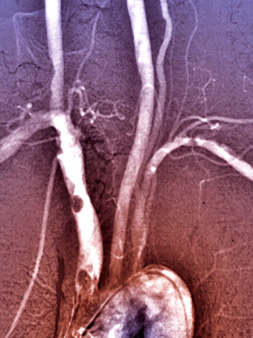 Atheroma in brachiocephalic artery, angiogram