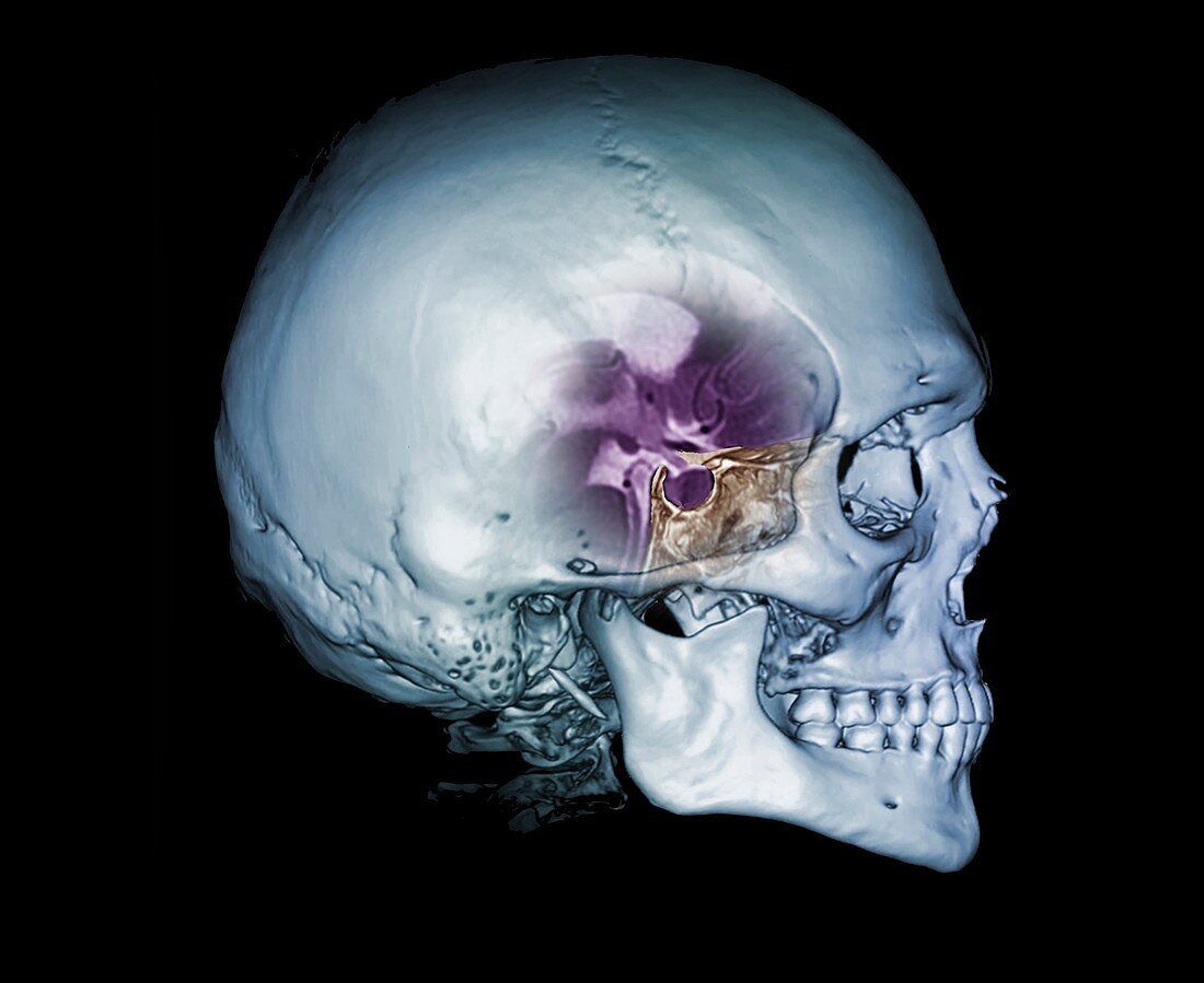 Human skull and site of pituitary gland, CT and MRI scans