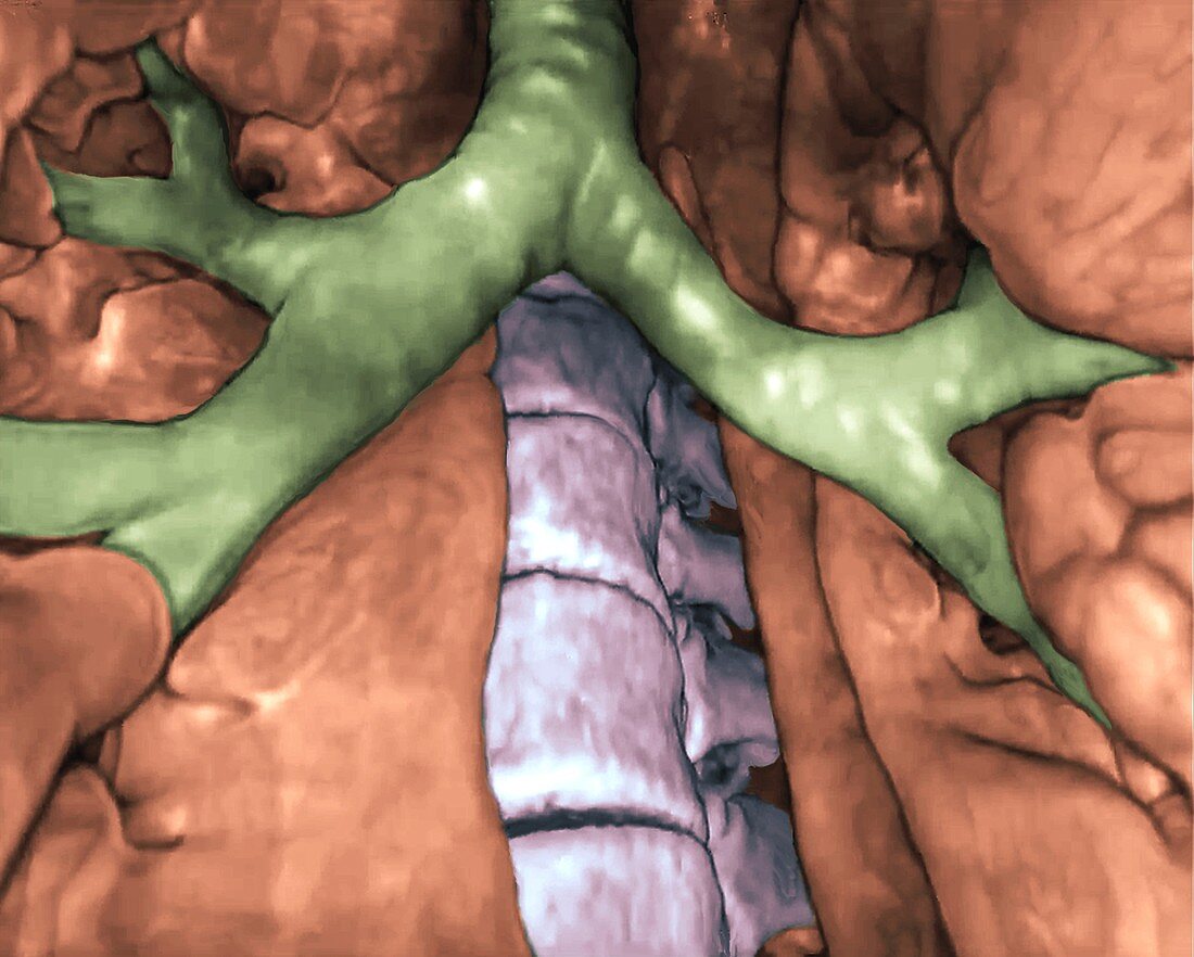 Bronchial divisions, 3D CT scan