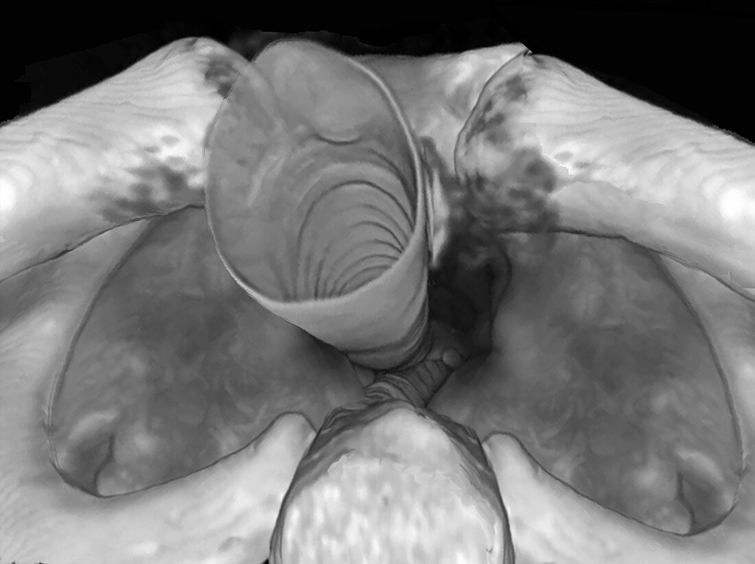 Upper trachea, 3D CT scan