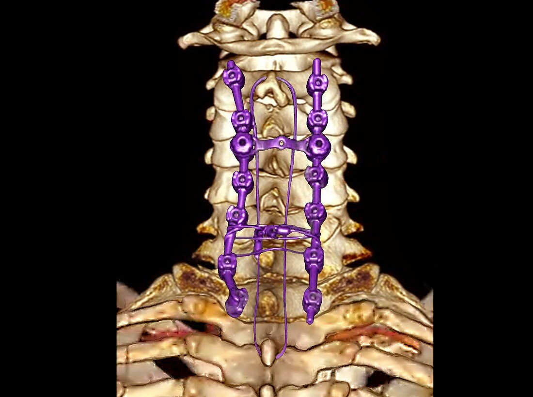Pinned neck vertebrae, 3D CT scan