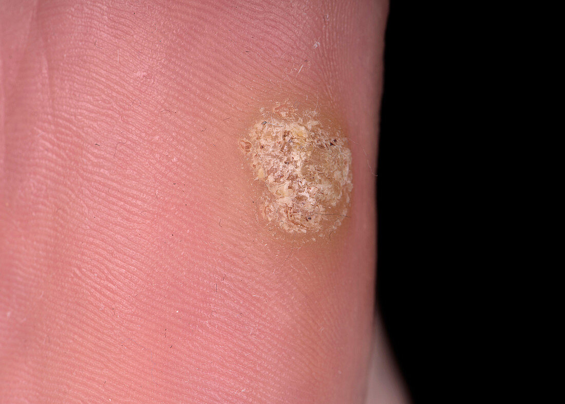 Common warts