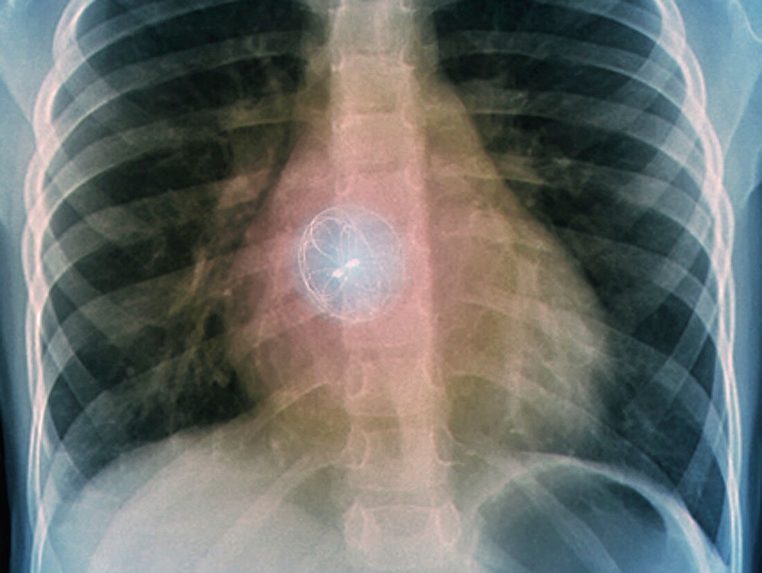 Heart defect implant, X-ray