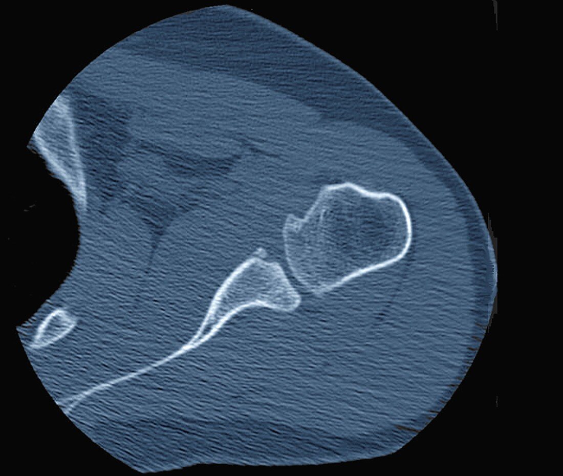 Shoulder joint lesion, CT scan