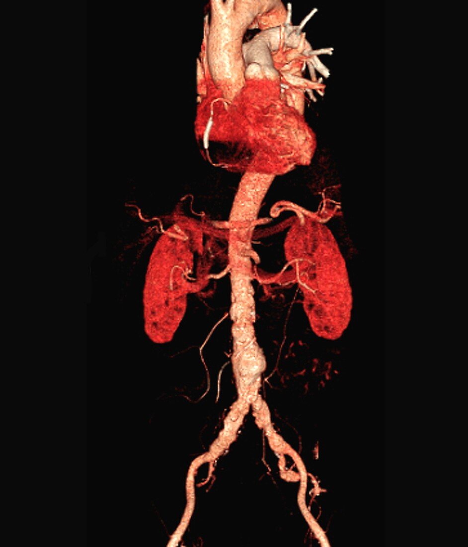 Cholesterol embolism, 3D CT angiogram