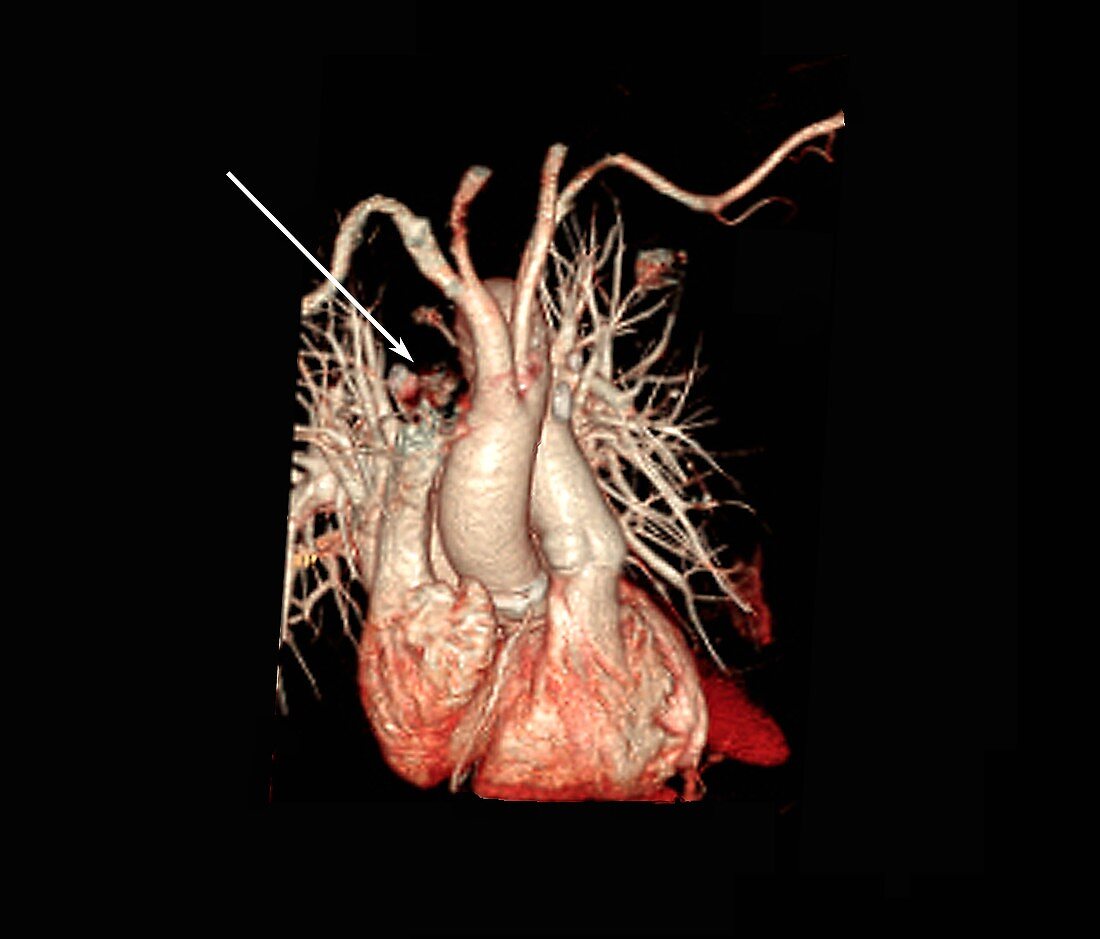 Pulmonary embolism, 3D CT angiography