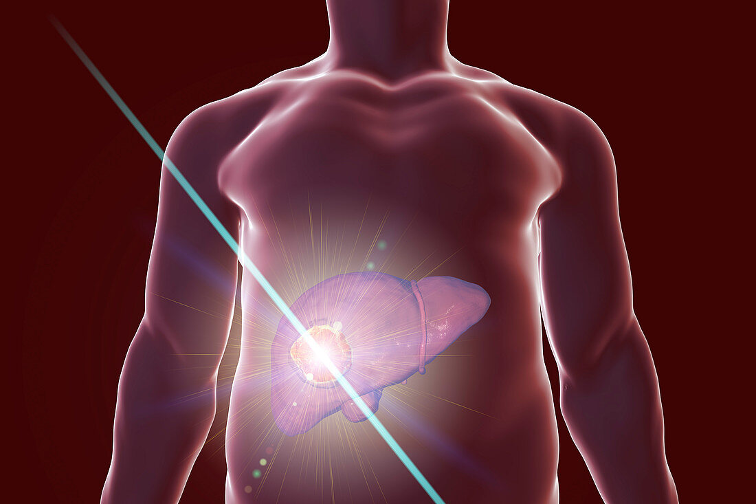 Liver cancer treatment, conceptual illustration