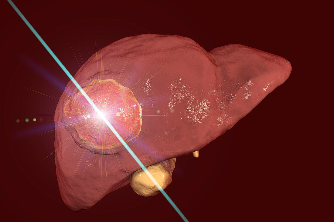 Liver cancer treatment with laser, illustration