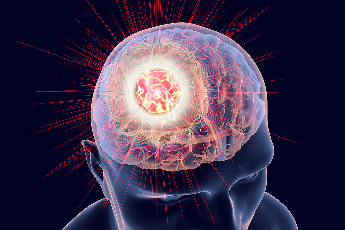 Brain cancer treatment, illustration