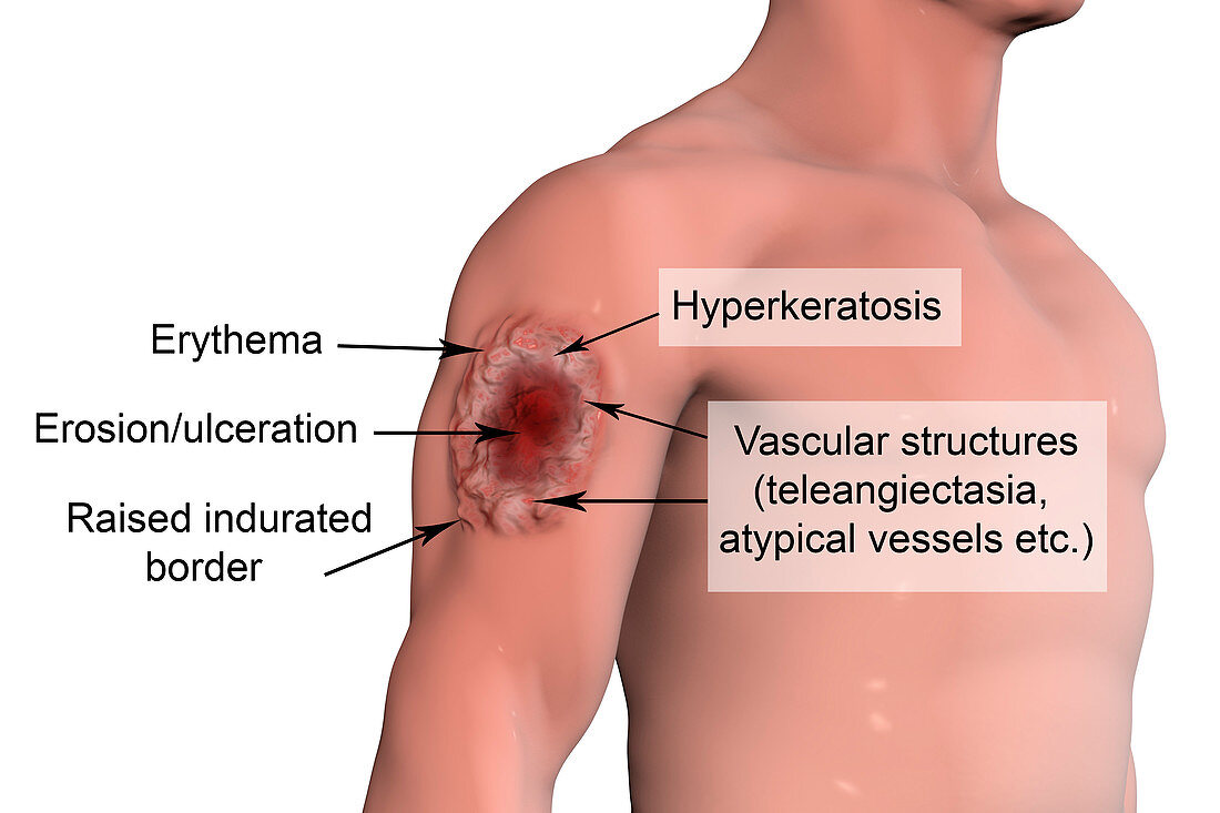 Skin ulcer in leishmaniosis, illustration