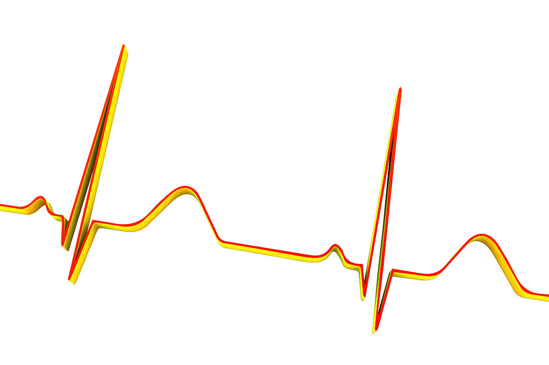 ECG, illustration