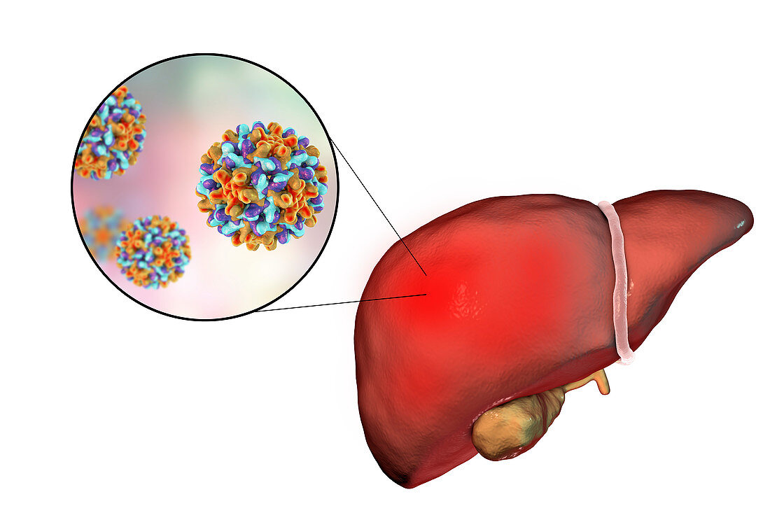 Hepatitis B, illustration
