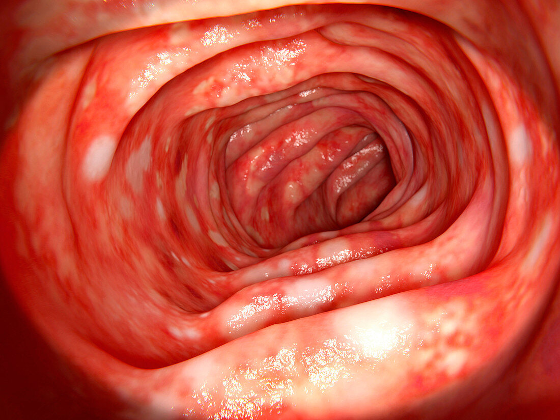 Ulcerative colitis, illustration