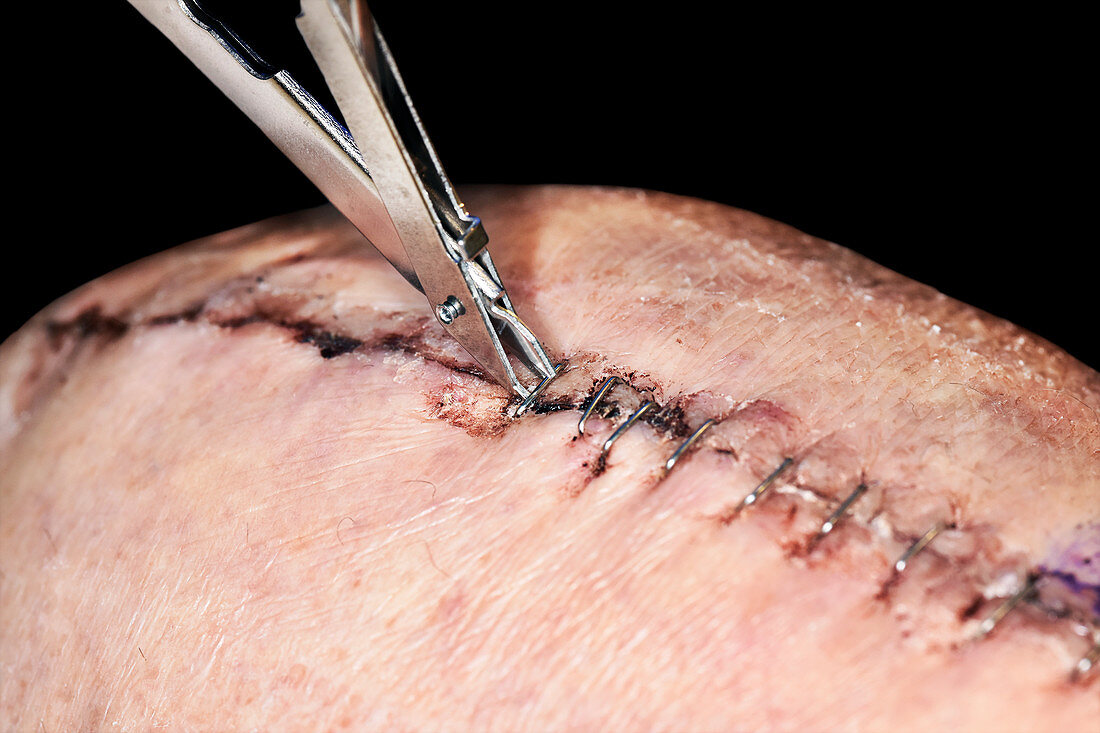 Knee replacement scar