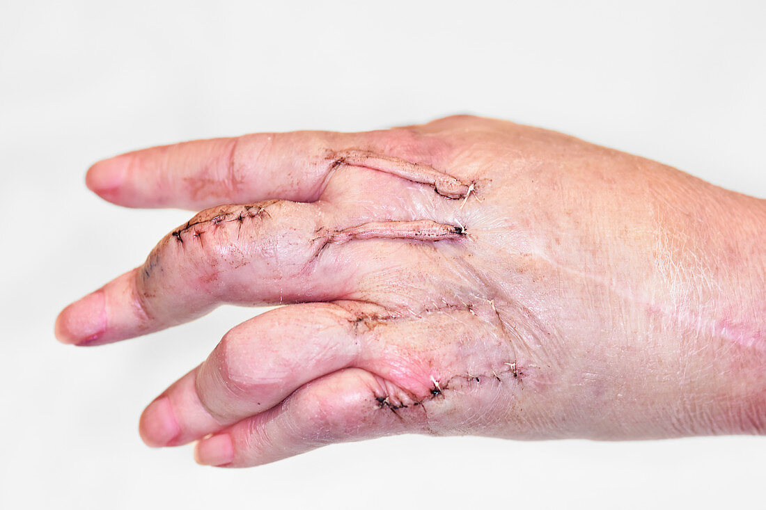 Hand joint fusion scars in rheumatoid arthritis