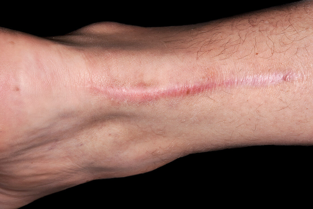 Scar from Achilles tendon surgery