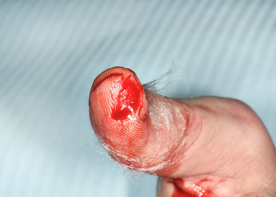 Laceration to thumb