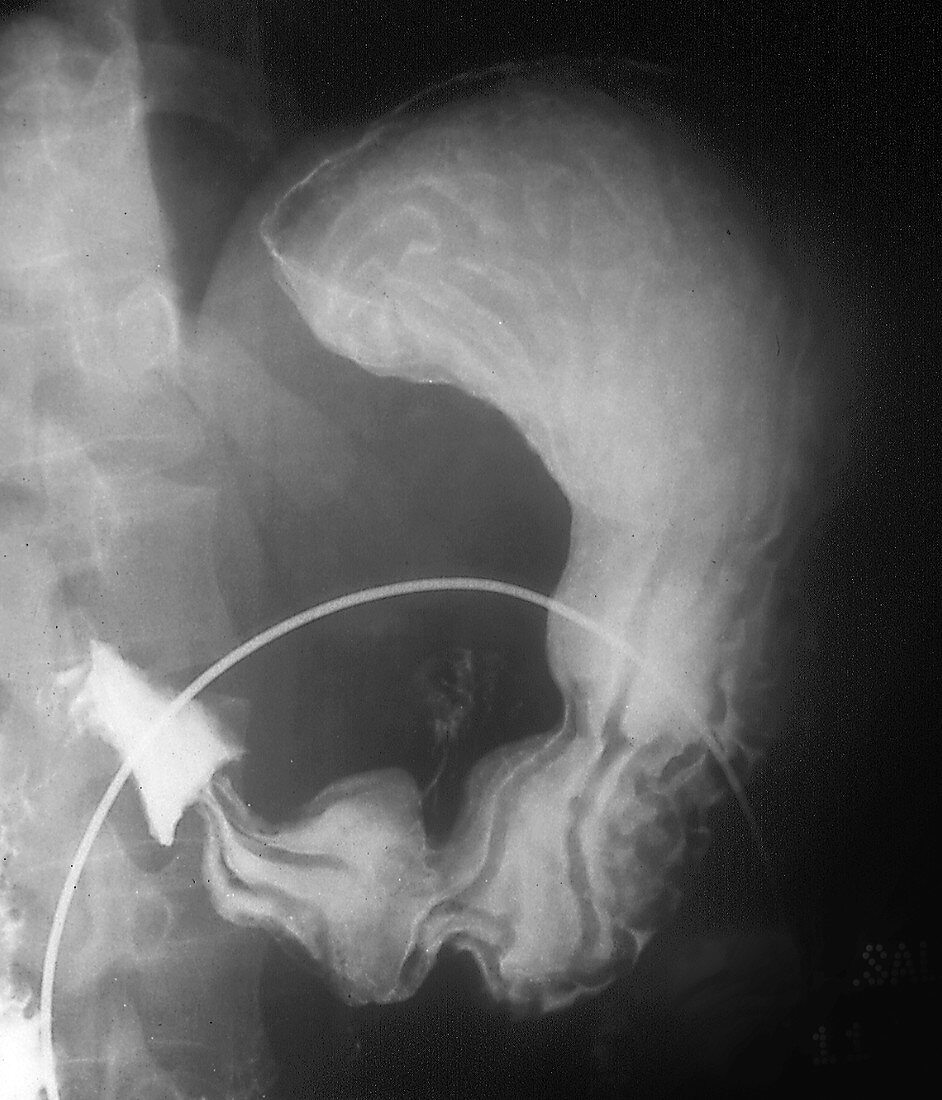 Gastritis,X-ray