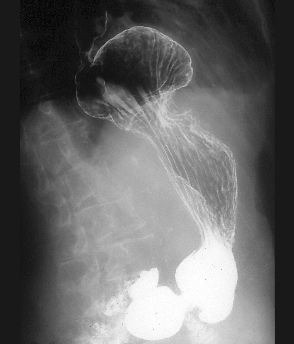 Diaphragmatic hernia,X-ray