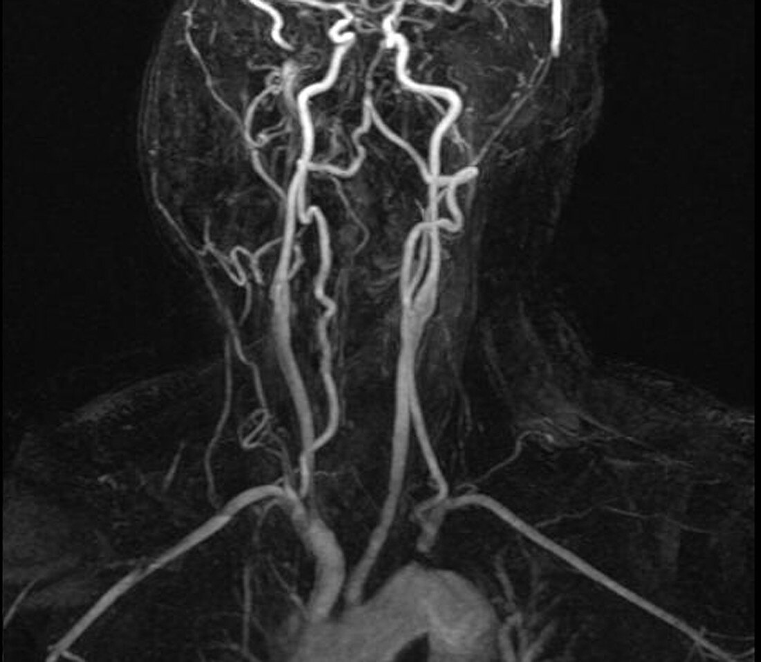 Left subclavian artery blockage,MRA scan