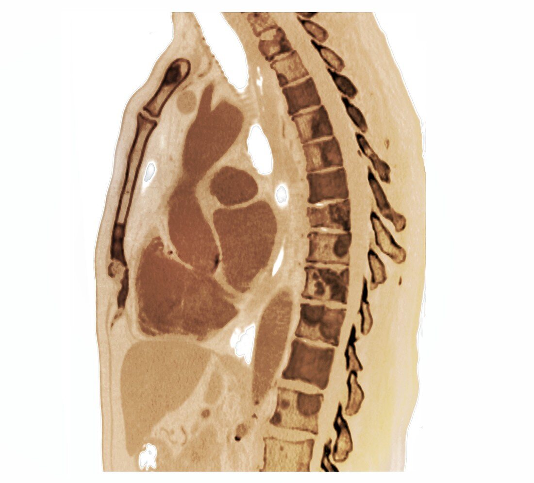 Secondary bone cancer in the spine,CT scan