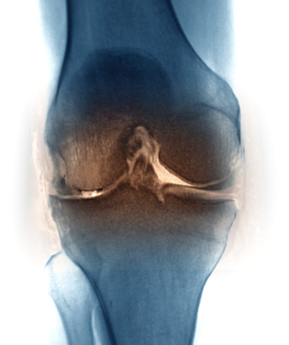 Osteoarthritis of the knee joint,X-ray and MRI scan