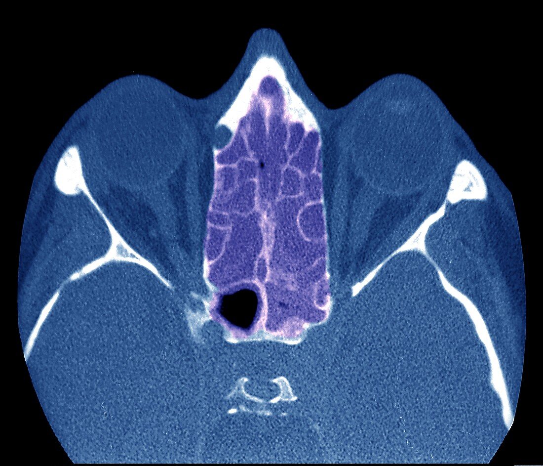 Ethmoid sinus infection,CT scan