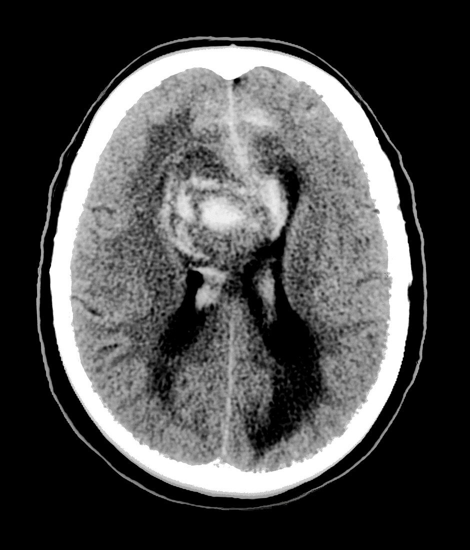Glioblastoma cancerous brain tumour,CT scan