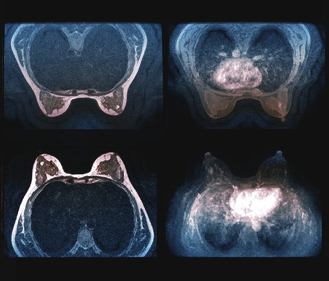 Breast tumour,MRI scans