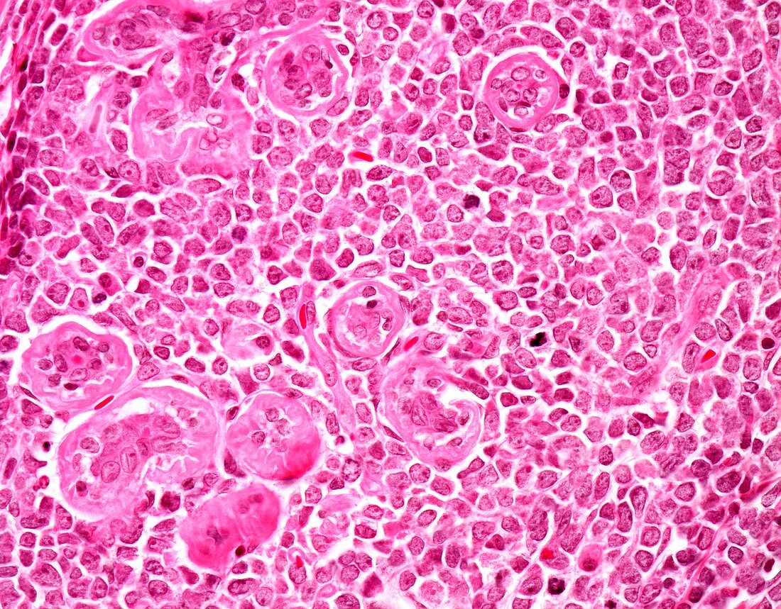 Myeloid sarcoma,light micrograph