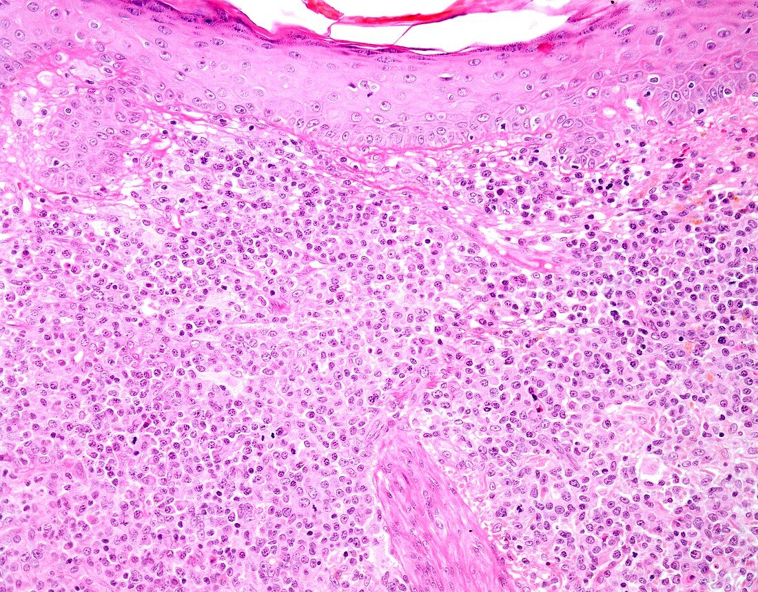 Myeloid sarcoma,light micrograph