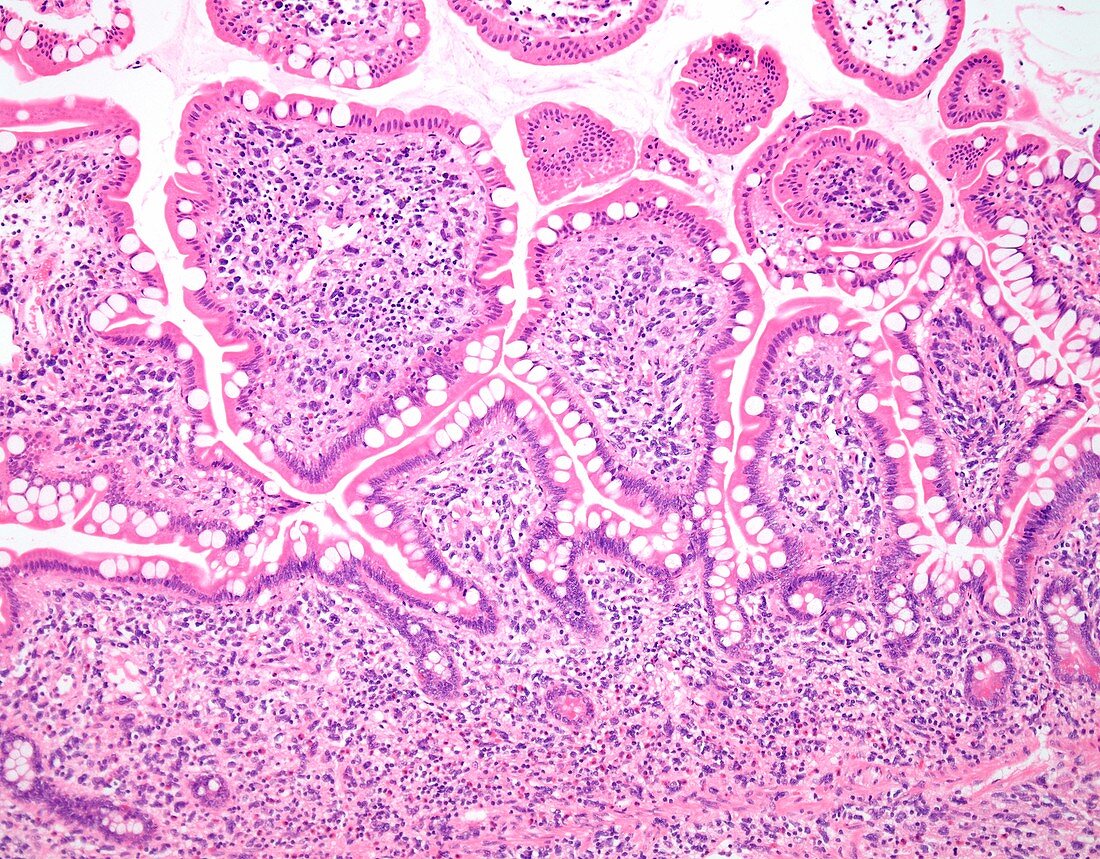 Histiocytic sarcoma,light micrograph