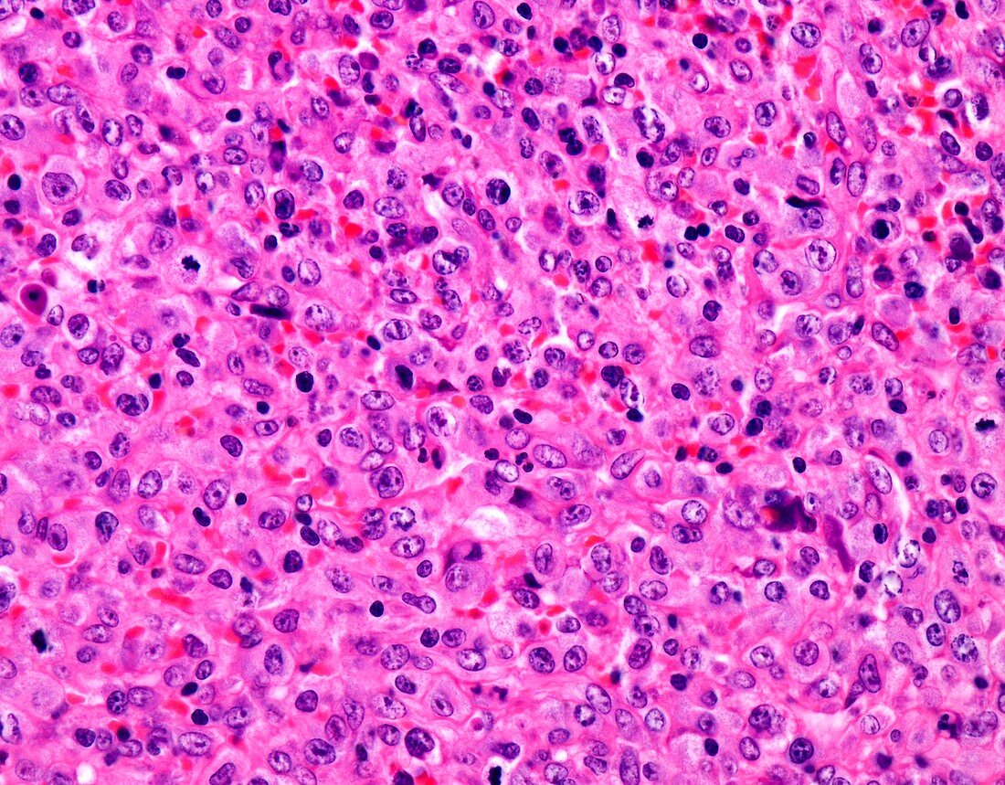 Peripheral T-cell lymphoma,light micrograph