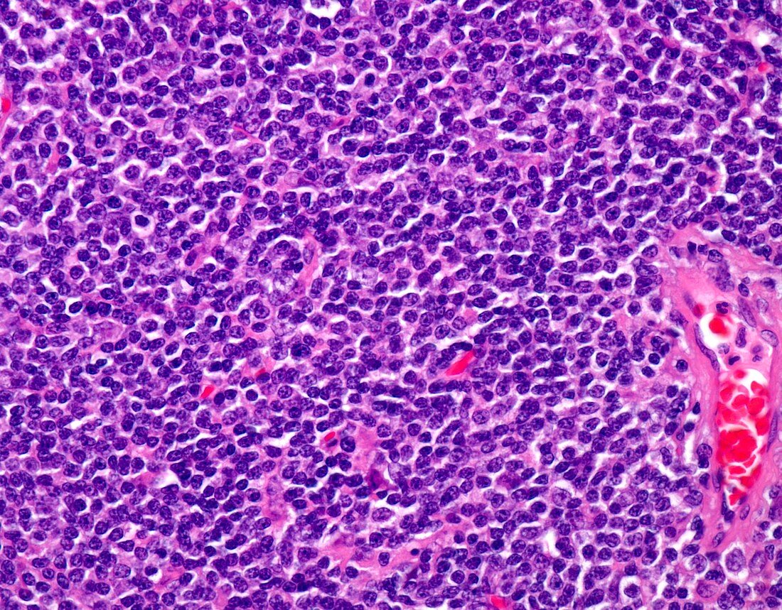 Small lymphocytic lymphoma,light micrograph