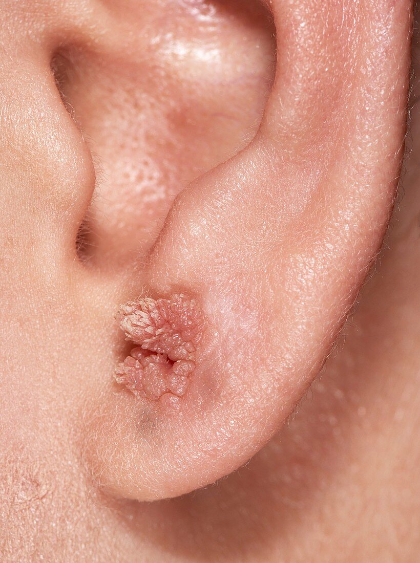 Wart at site of ear piercing