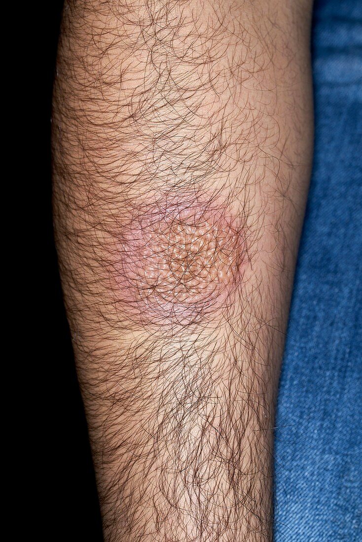 Erythema multiforme rash in herpes infection