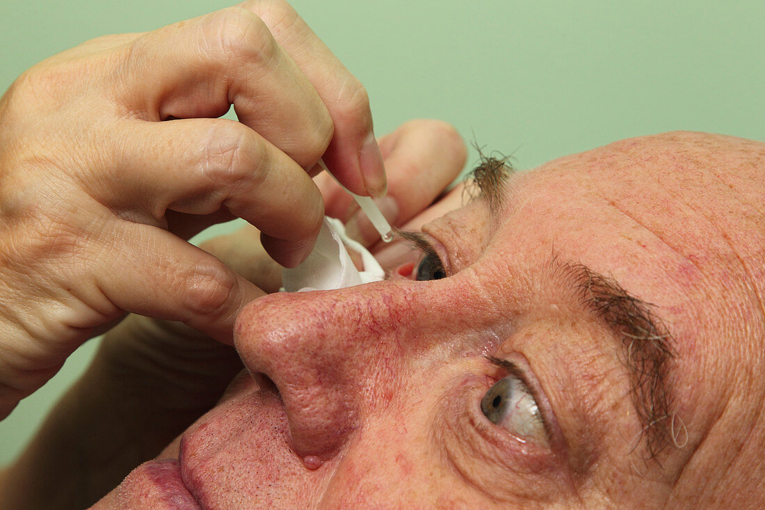 Putting eye drop into eye of patient