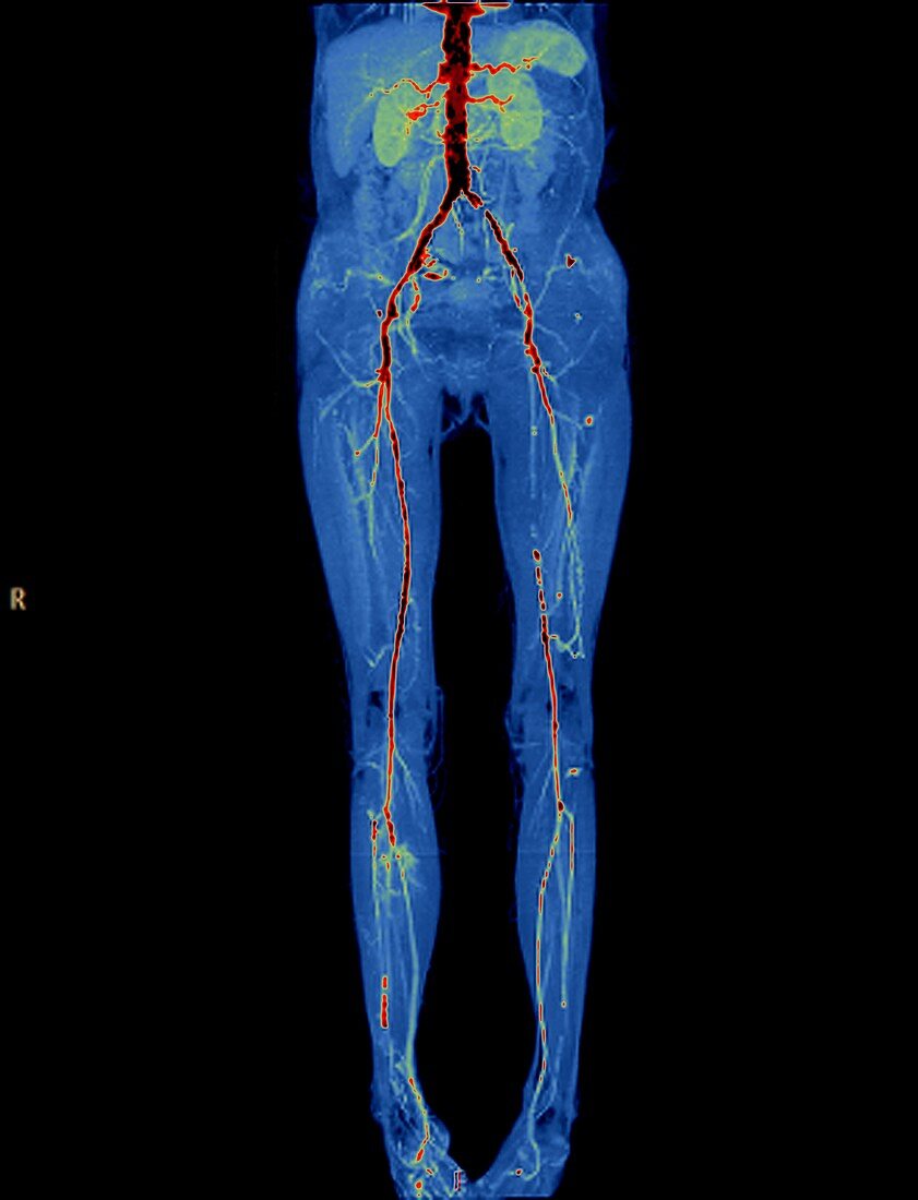 Vascular disease,CT scan
