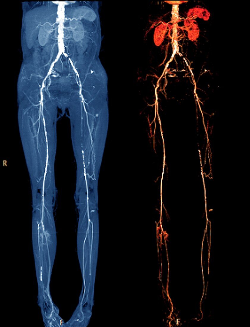 Vascular disease,CT scans