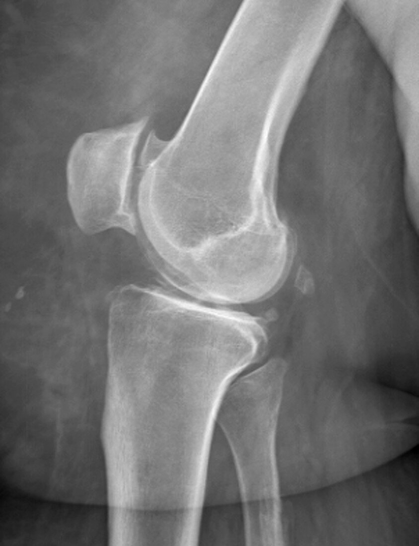Osteoarthritis of the knee in obesity,X-ray