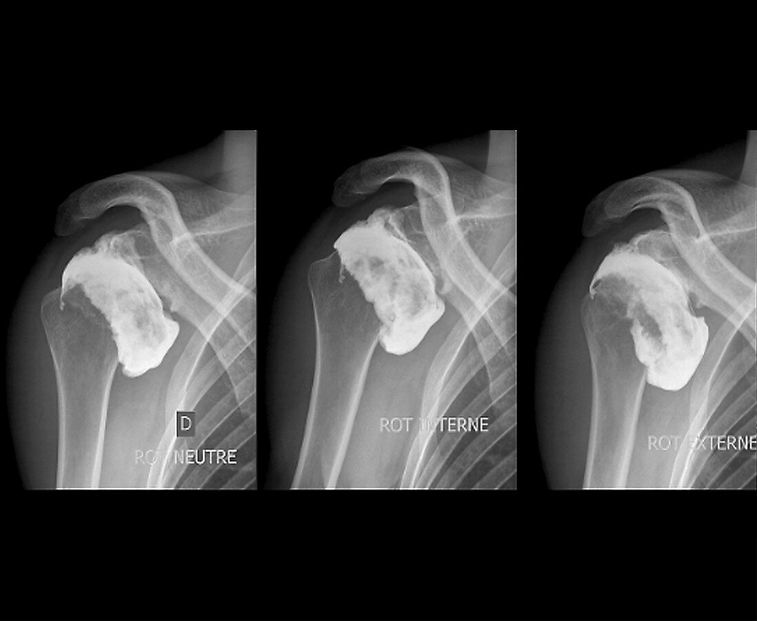 Complications following dislocated shoulder in sports injury