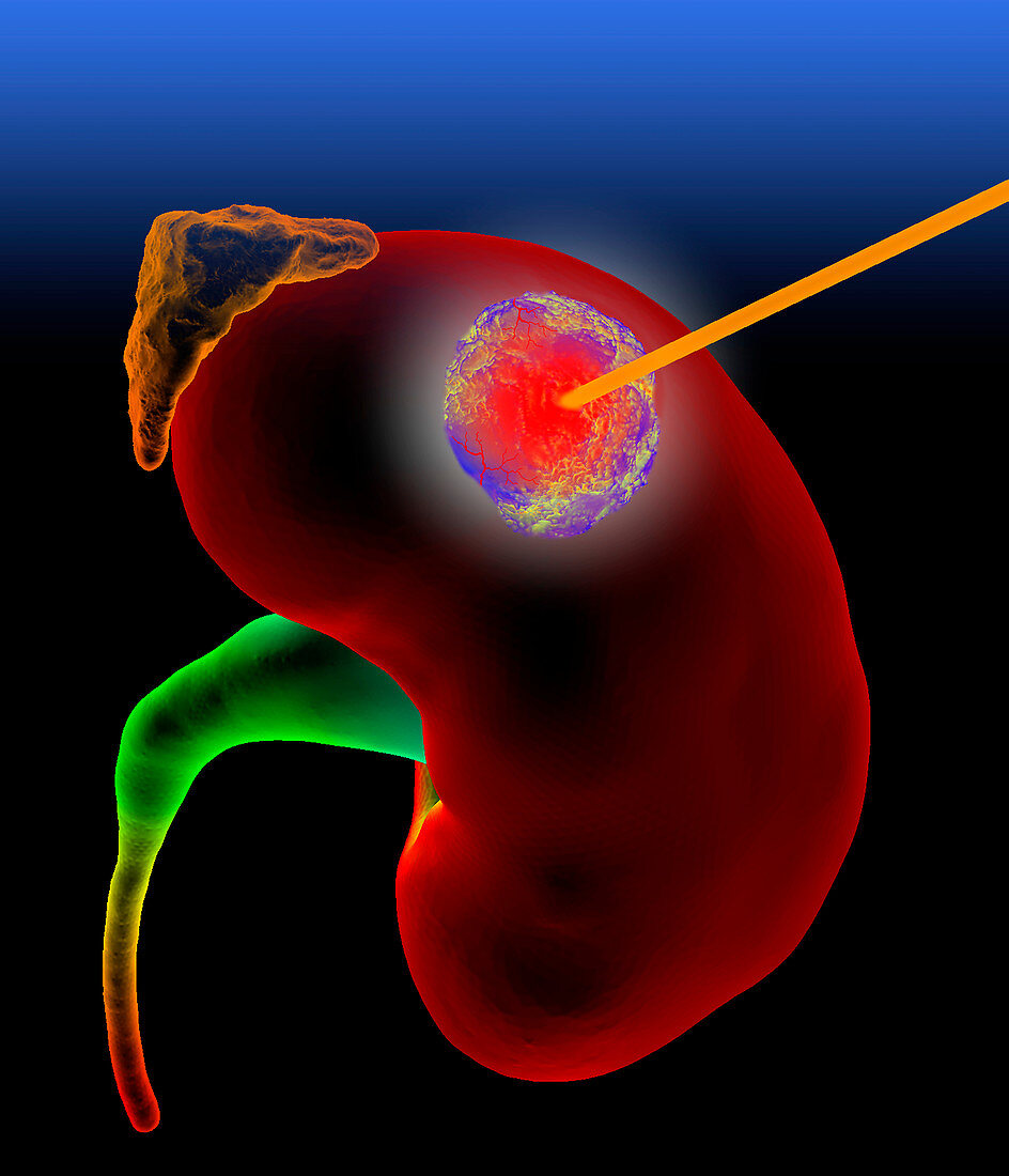 Kidney cancer thermal ablation,illustration