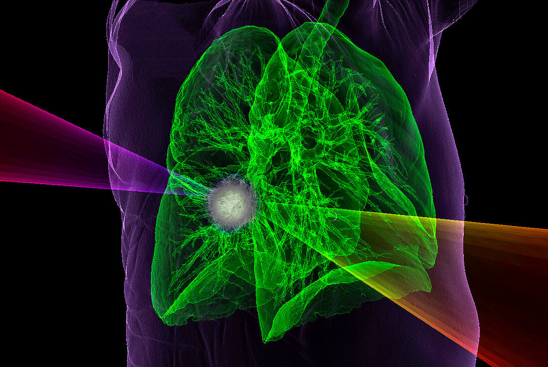 Lung cancer radiotherapy,3D CT-based illustration