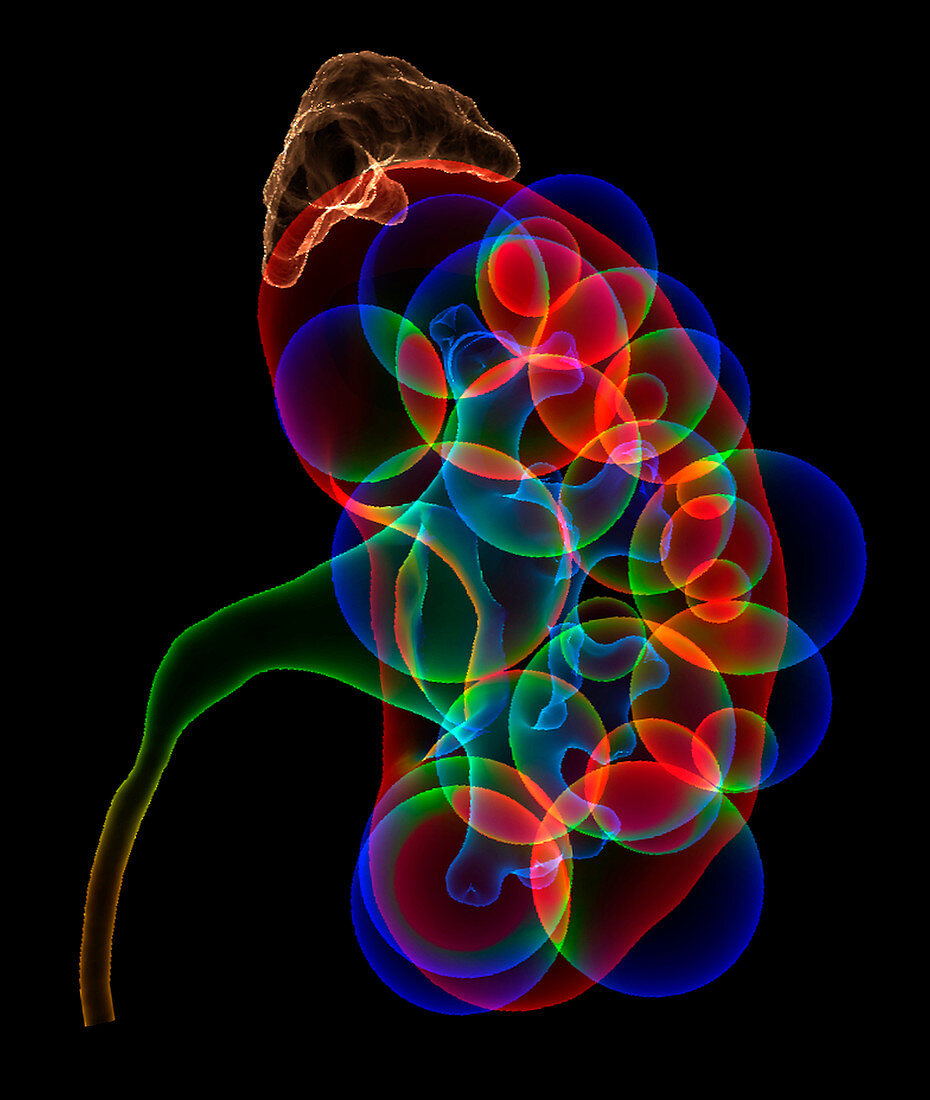 Polycystic kidney,illustration